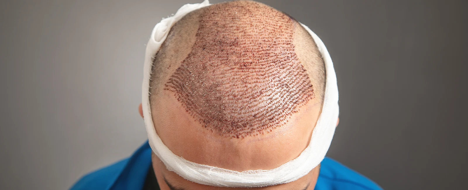 Implantes de pelo en Medellín
