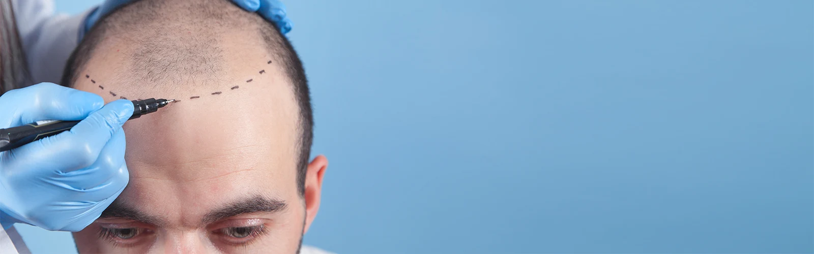 Microimplante Capilar Cabello